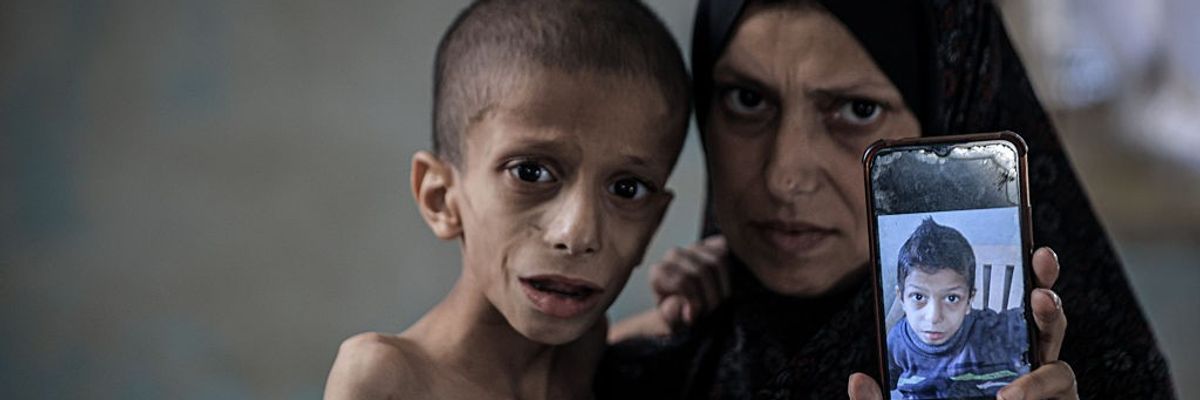 10-year-old Nafez fight malnutrition and brain atrophy as hunger crisis worsens in Gaza