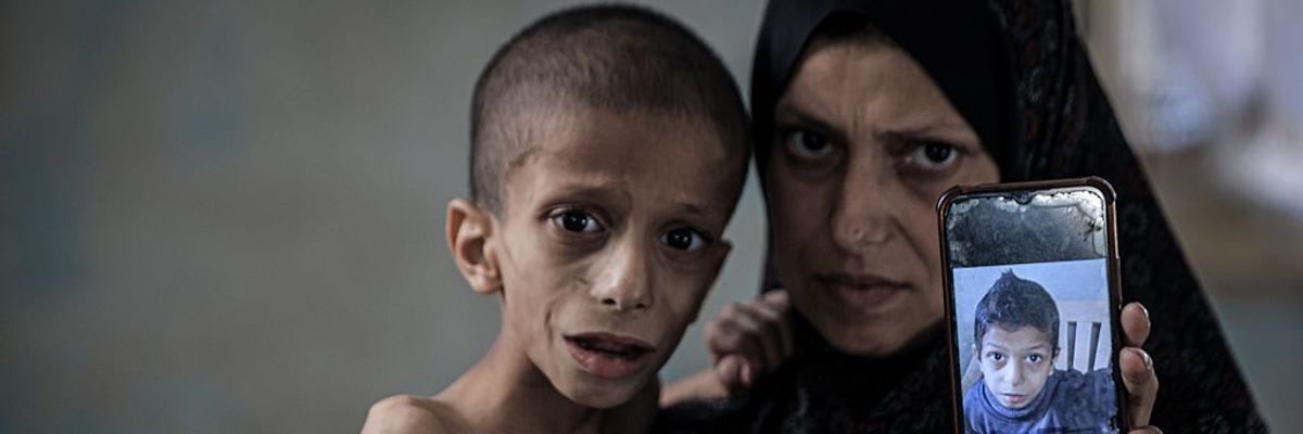 10-year-old Nafez fight malnutrition and brain atrophy as hunger crisis worsens in Gaza