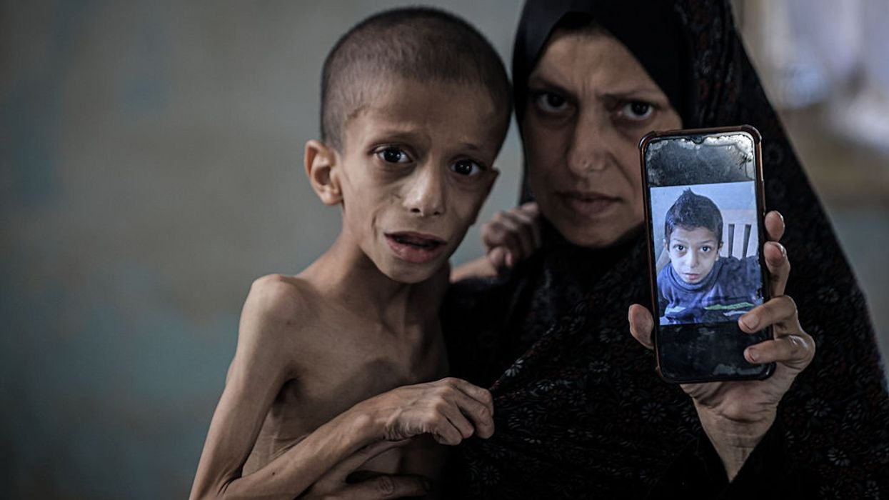 10-year-old Nafez fight malnutrition and brain atrophy as hunger crisis worsens in Gaza