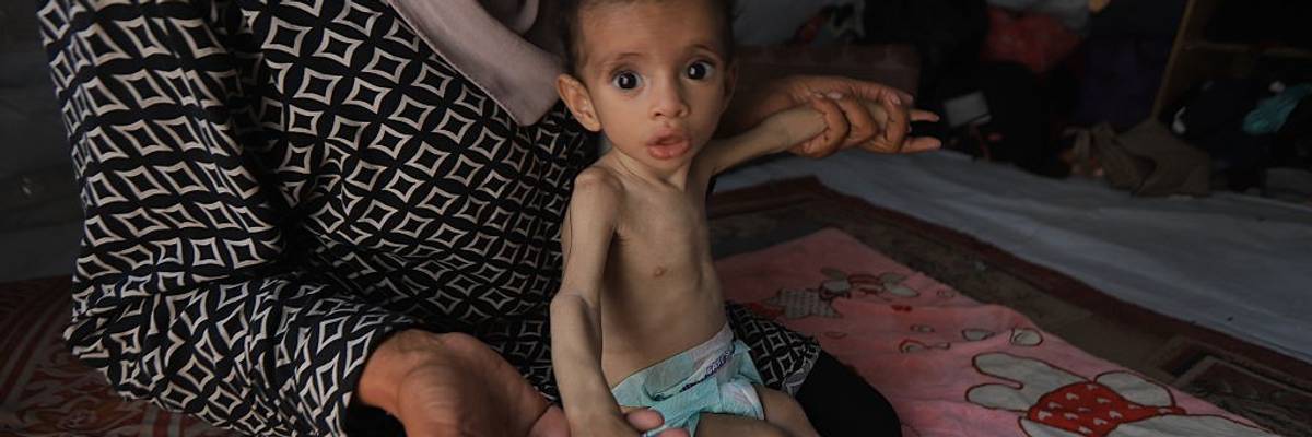 11-month-old baby's life at risk due to malnutrition in Gaza
