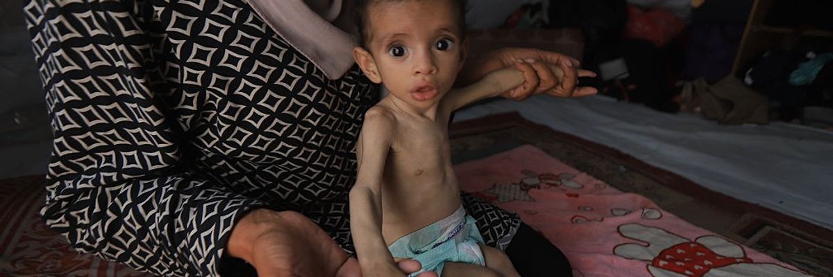 11-month-old baby's life at risk due to malnutrition in Gaza