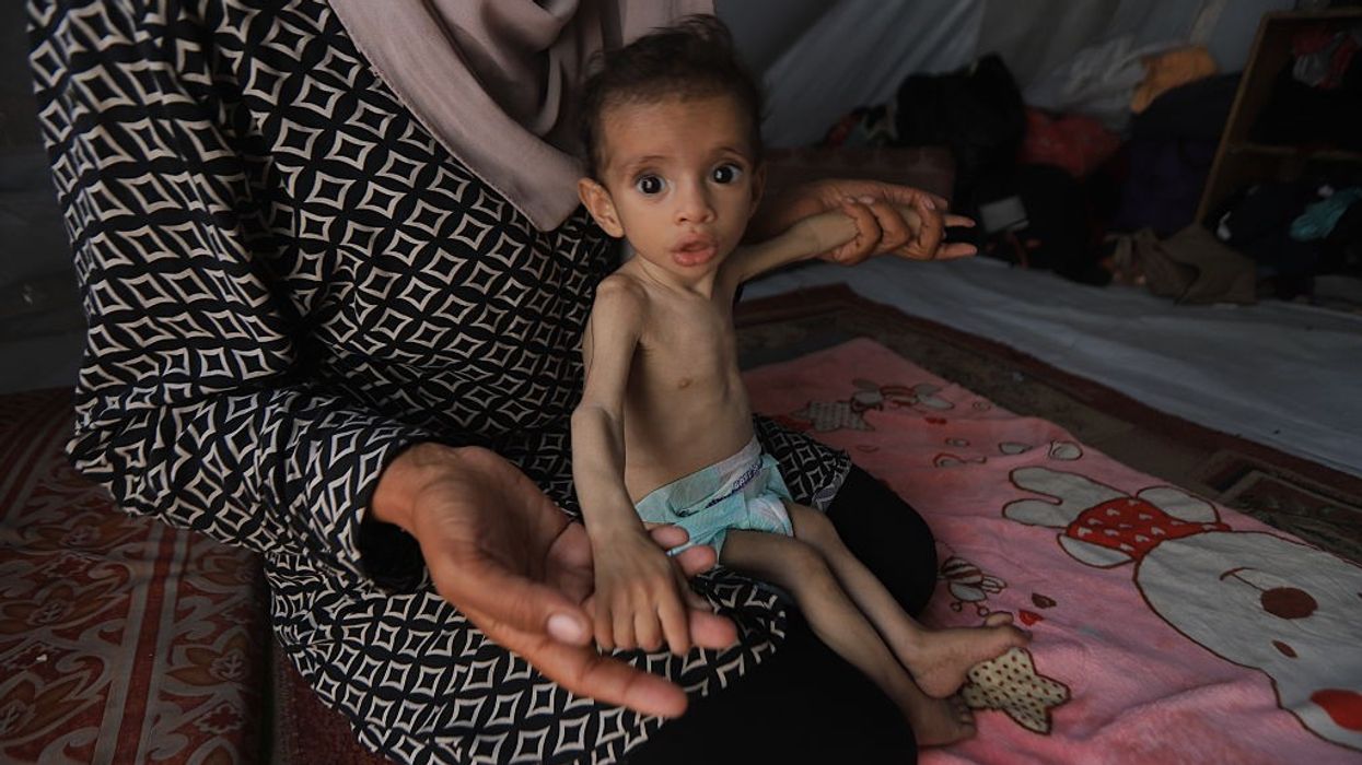 11-month-old baby's life at risk due to malnutrition in Gaza