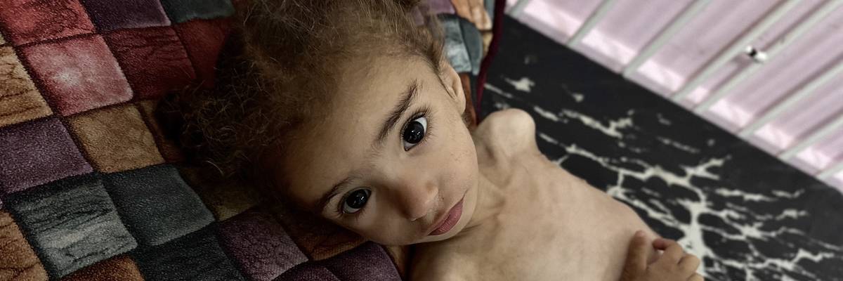 18-month-old Mayar El Arca is being treated at Nasser Hospital