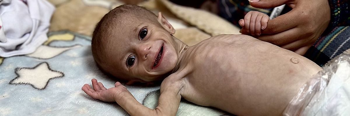5-month-old baby struggles with malnutrition in Gaza amid food crisis