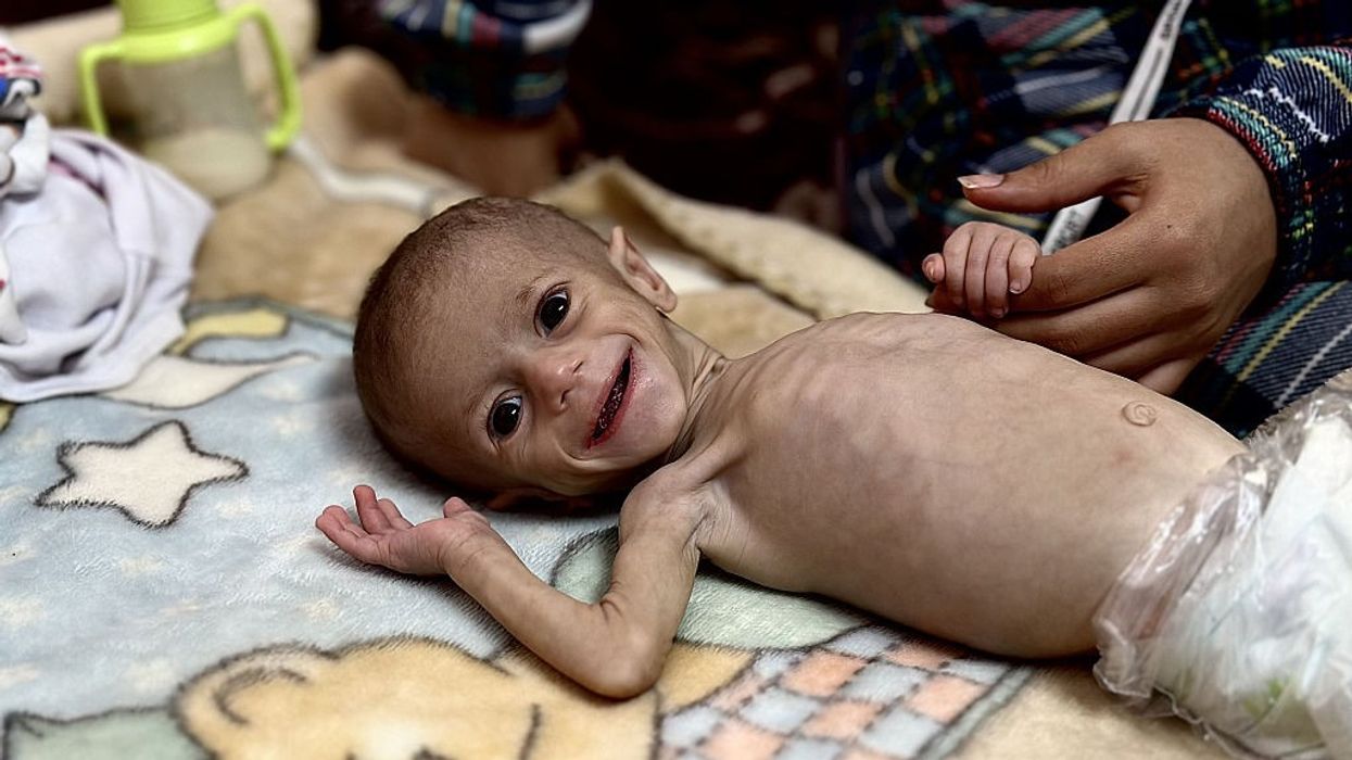 5-month-old baby struggles with malnutrition in Gaza amid food crisis