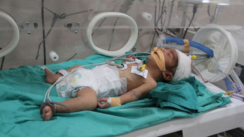 A baby, hospitalized due to malnutrition and dehydration, in Gaza on March 2, 2024