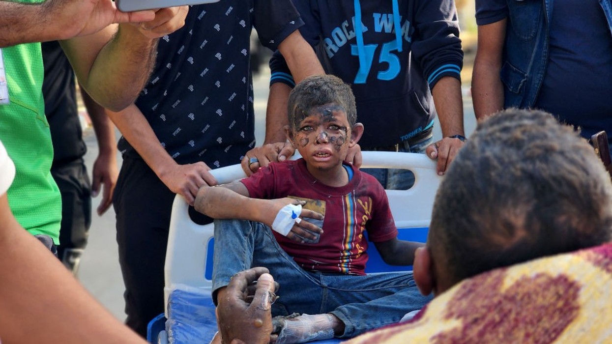 A burned Palestinian child is treated following an Israeli airstrike on Gaza