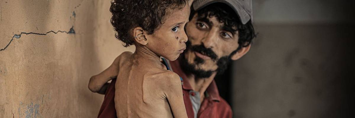 A man holds a starving Palestinian child in Gaza