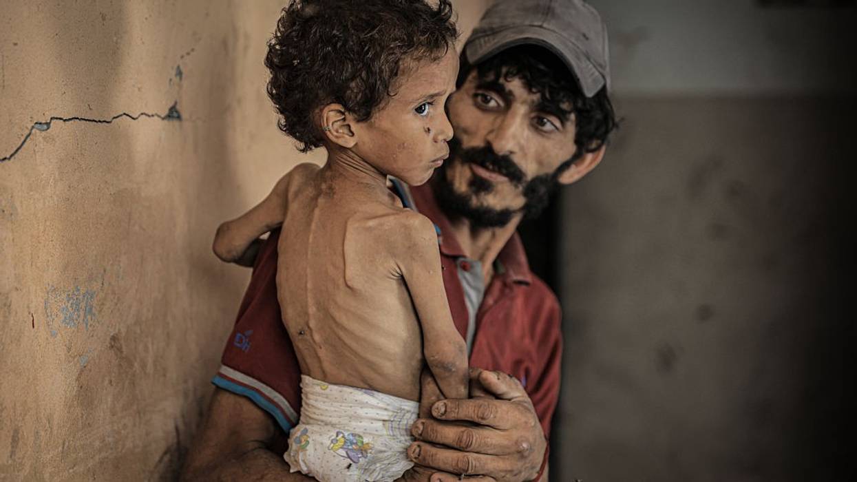 A man holds a starving Palestinian child in Gaza
