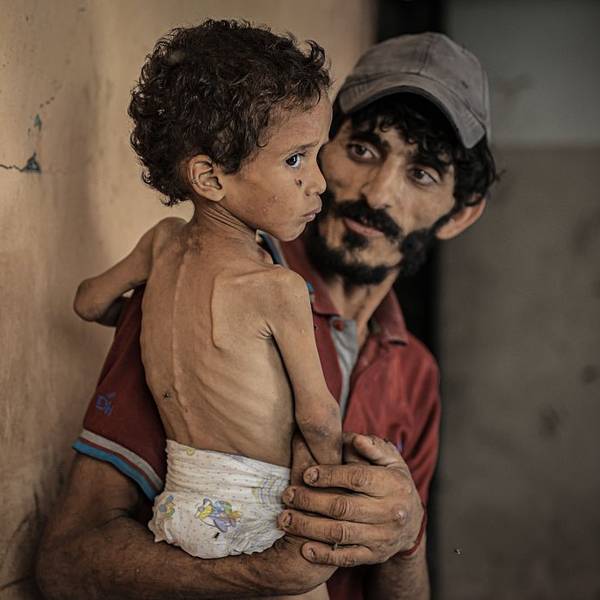 A man holds a starving Palestinian child in Gaza