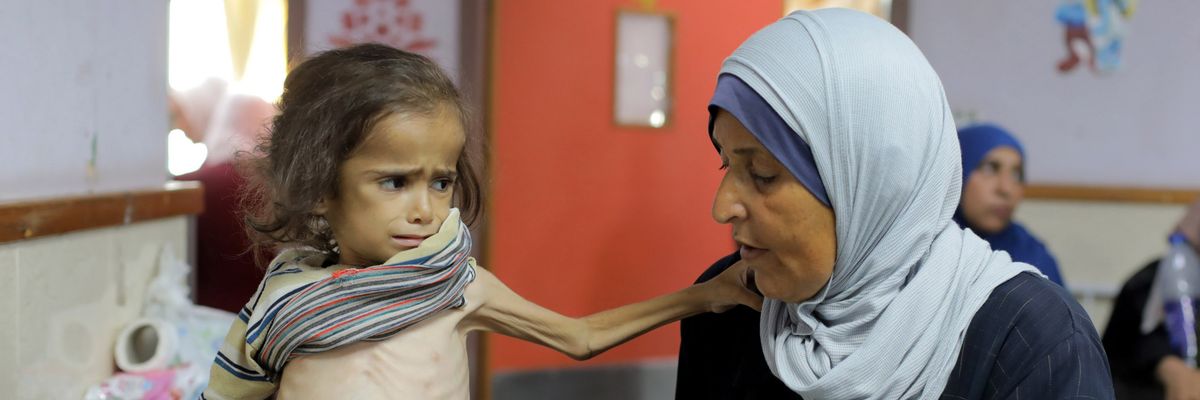 A Palestinian child suffering from malnutrition