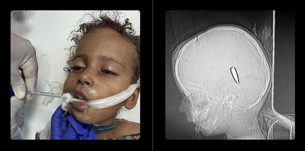 A Palestinian girl shot by an Israeli soldier, and another X-ray photo showing the bullet in her head