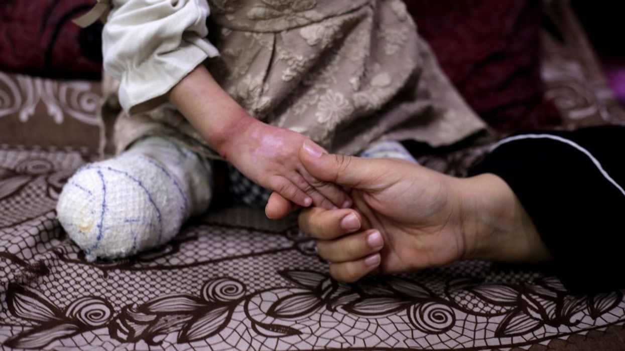 Child with amputations in Gaza.