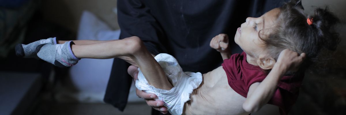 Five-year-old Misk Bilal al-Madhoun struggles to survive