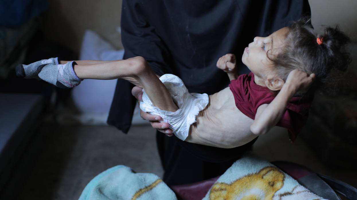 Five-year-old Misk Bilal al-Madhoun struggles to survive