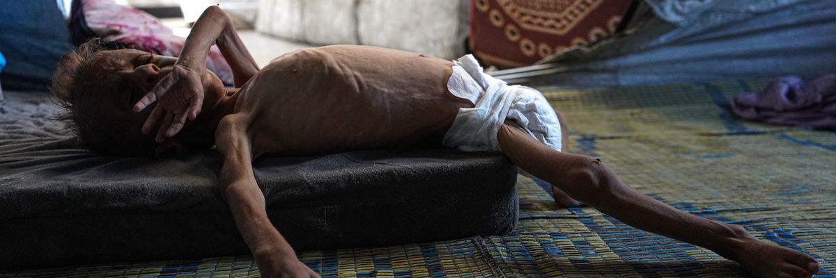 Gaza toddler with acute malnutrition.