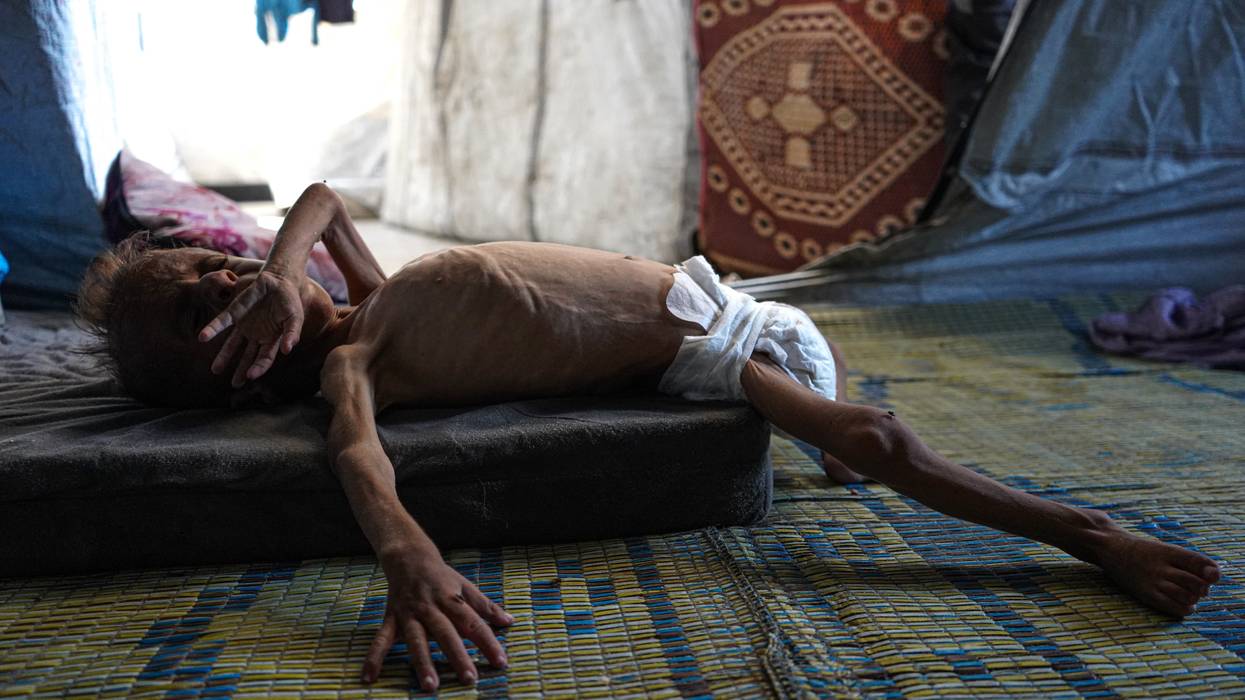 Gaza toddler with acute malnutrition.