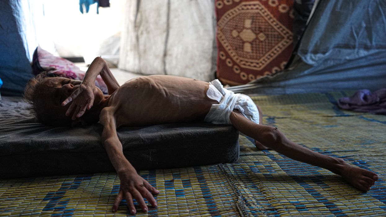 Gaza toddler with acute malnutrition.