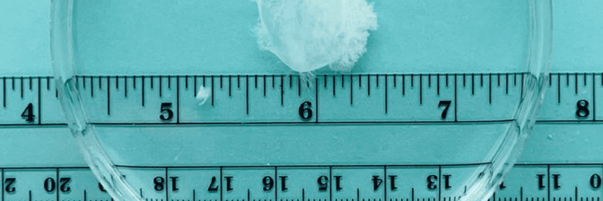 Image under microscope of aborted matter from a six-week pregnancy.