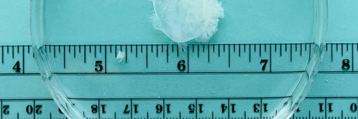 Image under microscope of aborted matter from a six-week pregnancy.