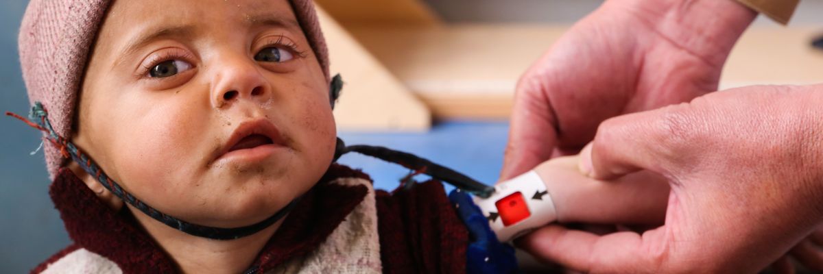 malnourished 18-month-old Afghan baby
