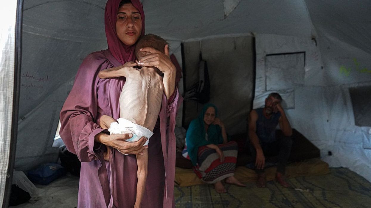 Malnourished Palestinian toddler becomes symbol of Gaza's humanitarian crisis amid Israeli blockade
