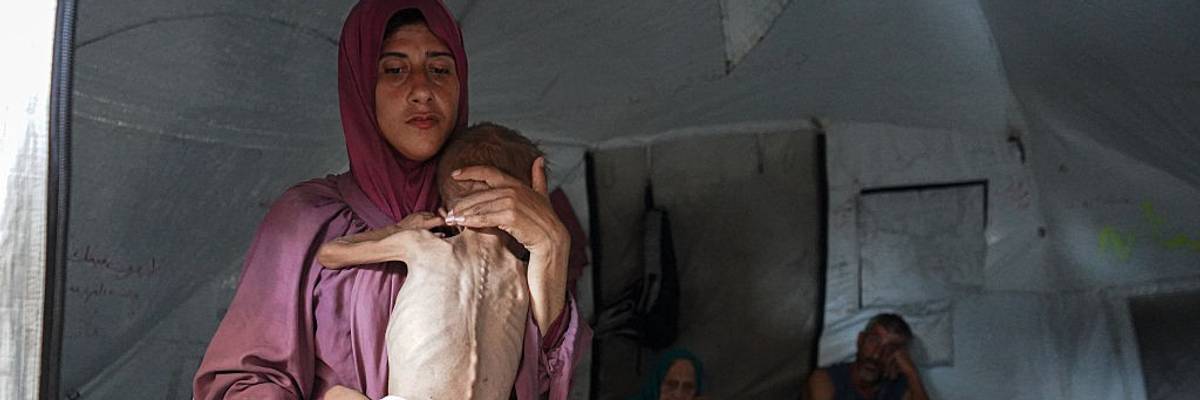 Malnourished Palestinian toddler held by his mother