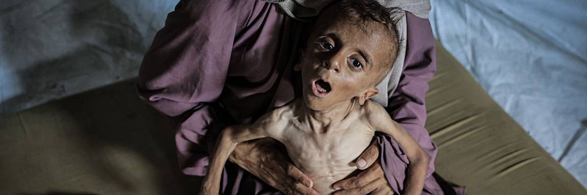 Malnourished toddler in Gaza fights for life amid ongoing Israeli attacks
