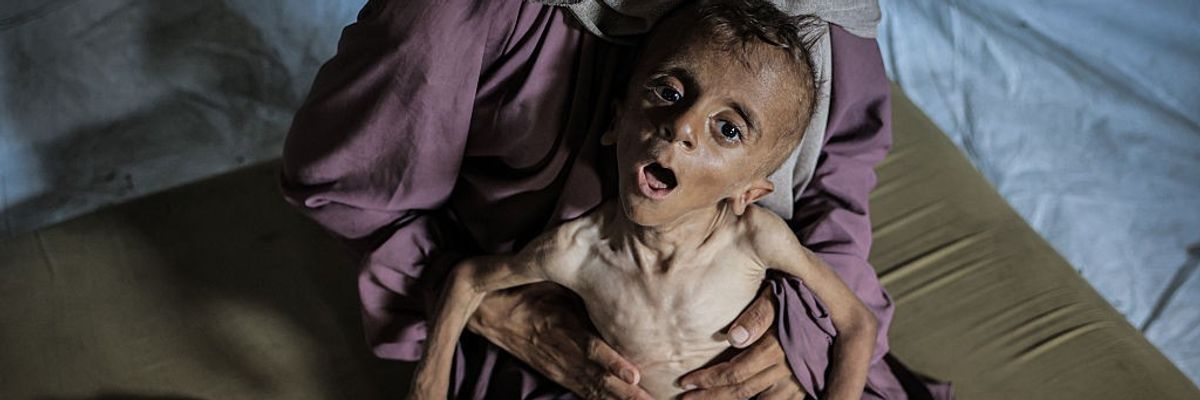 Malnourished toddler in Gaza fights for life amid ongoing Israeli attacks