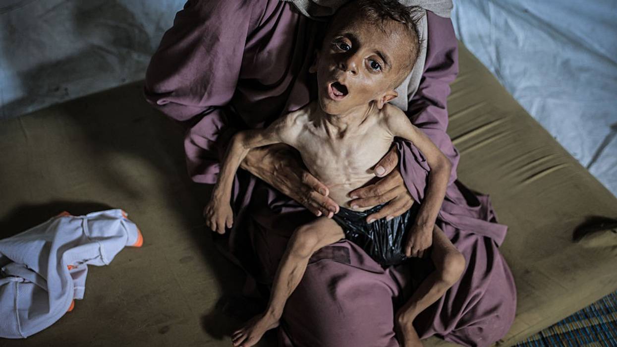 Malnourished toddler in Gaza fights for life amid ongoing Israeli attacks