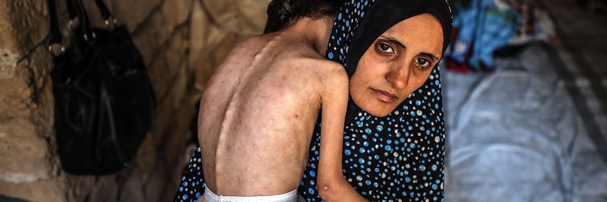 Malnutrition Emergency In Gaza
