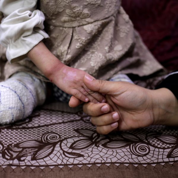 MIDEAST-GAZA-DEIR AL-BALAH-CHILD AMPUTEES