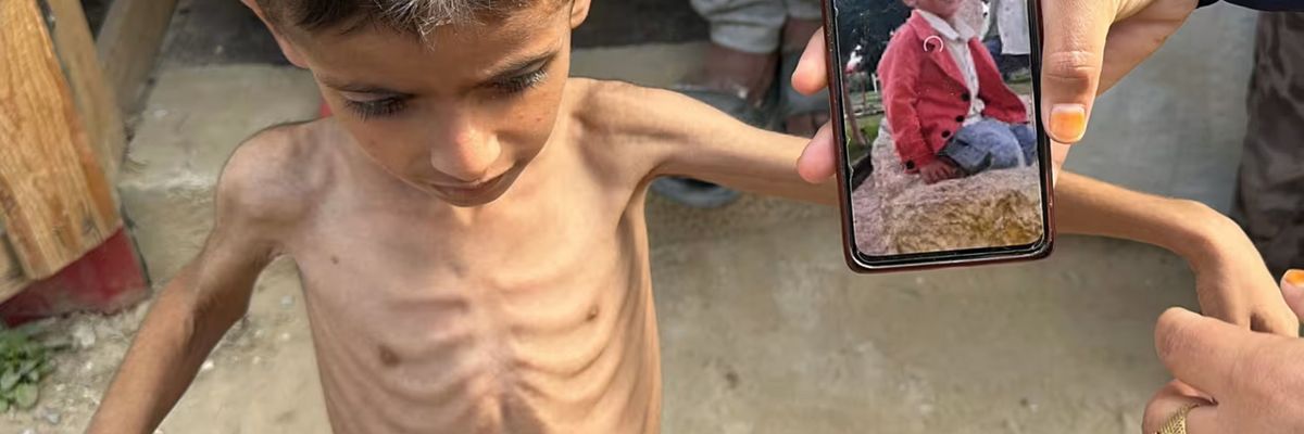 Osama Al-Raqab, 6, is one of thousands of Gazan children slowly starving.