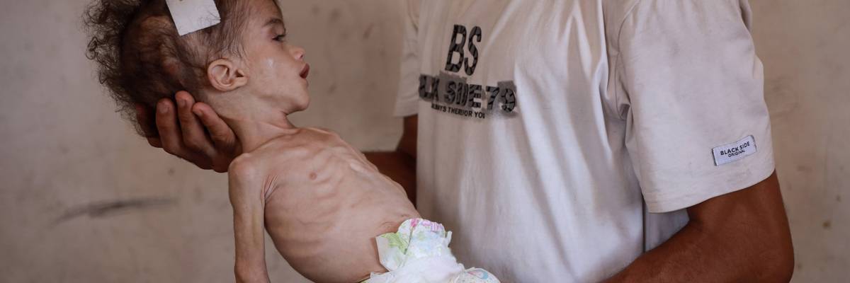 Palestinian toddler fights severe malnutrition amid blockade in Gaza