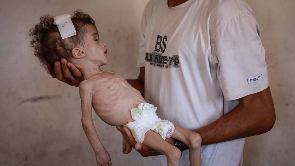 Palestinian toddler fights severe malnutrition amid blockade in Gaza
