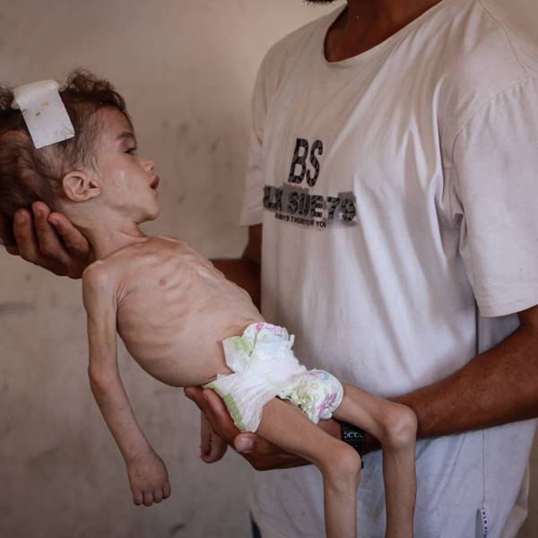 Palestinian toddler fights severe malnutrition amid blockade in Gaza