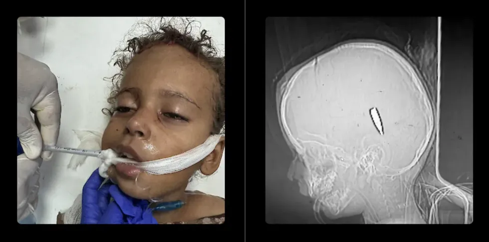 This Palestinian girl survived an Israeli bullet in the head\u2014a photo and X-ray image of her
