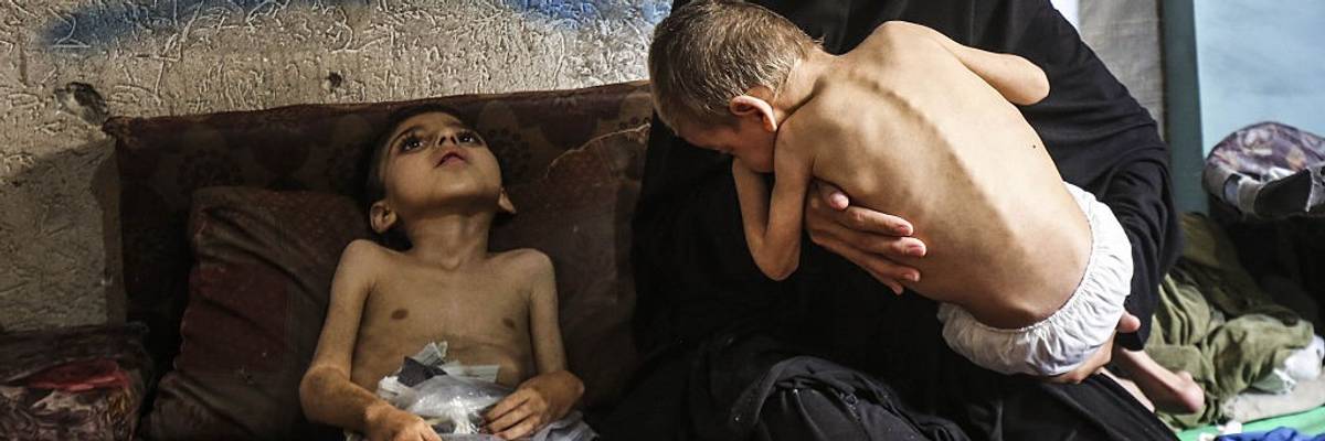 Two Palestinian brothers suffer from malnutrition amid Israeli attacks on Gaza