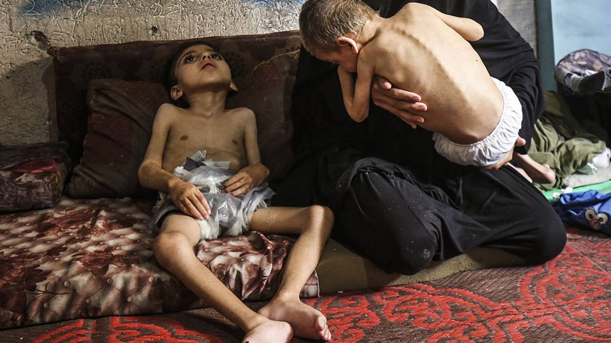 Two Palestinian brothers suffer from malnutrition amid Israeli attacks on Gaza
