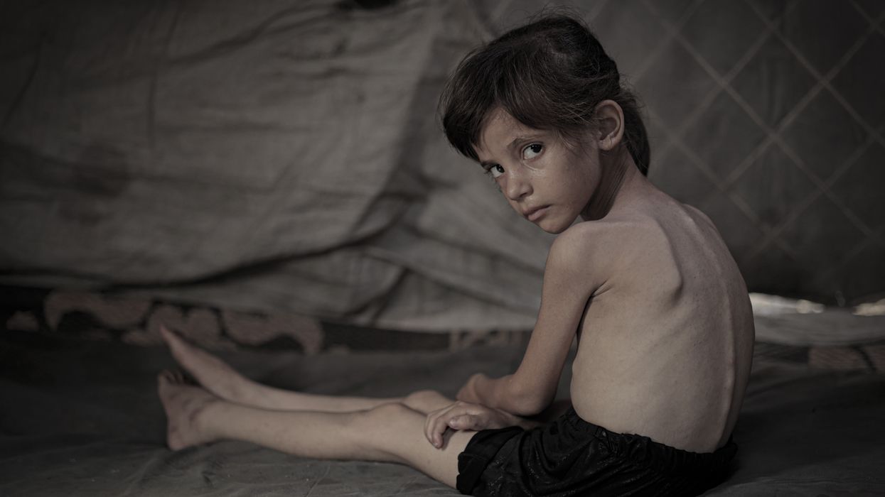 Young girl with malnutrition in Gaza.