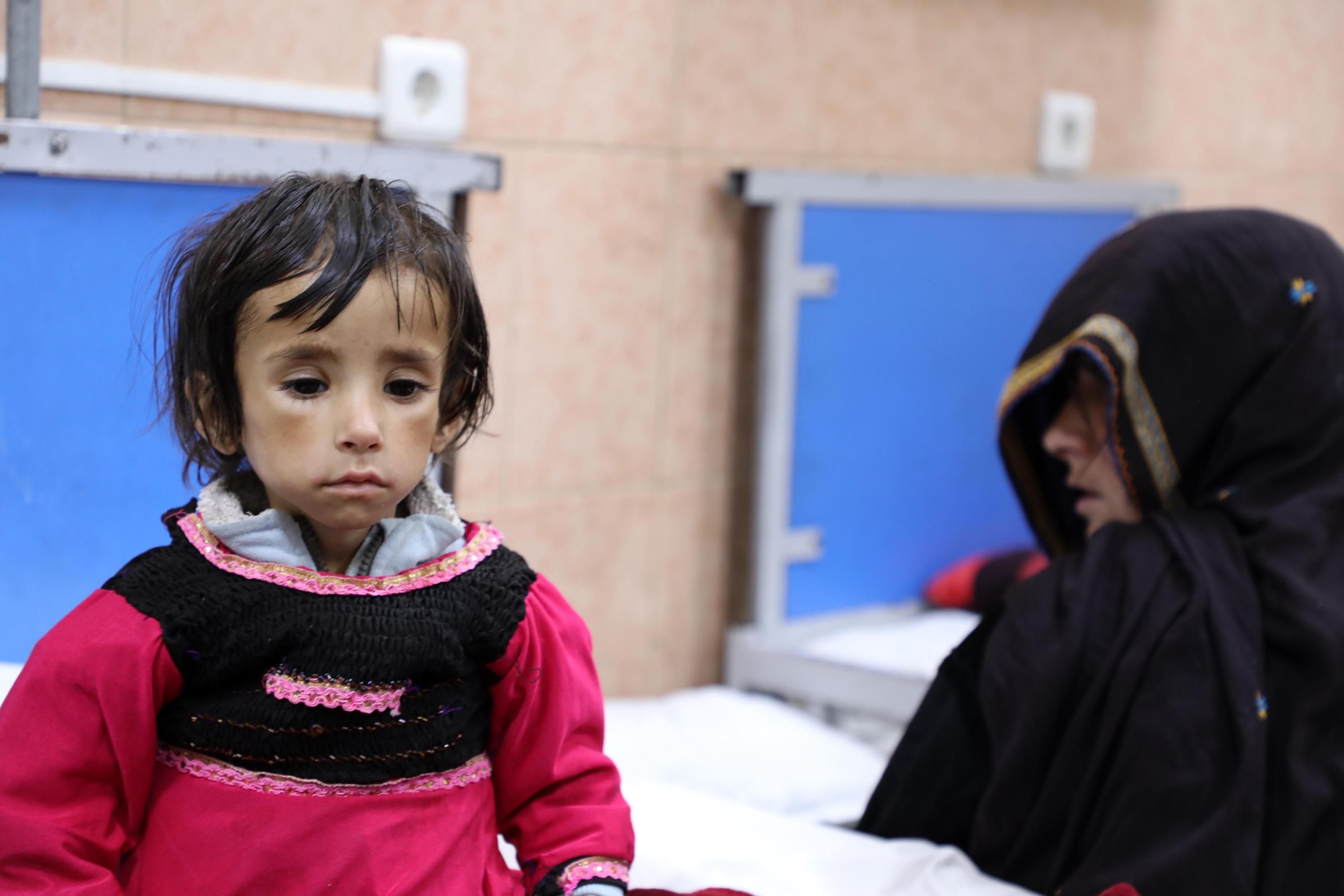 An Afghan child suffering from malnutrition is seen at a hospital in Kabul, Afghanistan on January 16, 2022