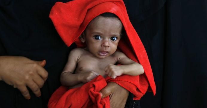 A mother holds her malnourished child to be weighed as he receives treatment at Al-Jumhori hospital in Saada province, March 19, 2020.
