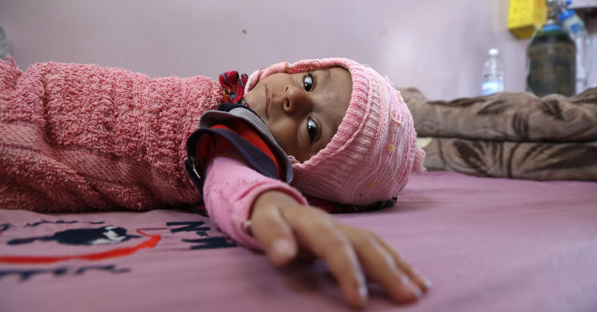 A Yemeni malnourished child lies on a bed where he receives treatment at the malnutrition treating department in Al-Sabeen hospital on January 26, 2021 in Sana'a, Yemen.