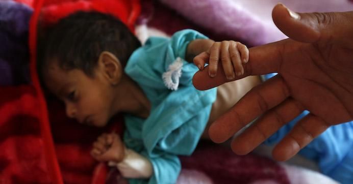 A malnourished child holds the finger of his father as he receives treatment at a hospital on June 30, 2020 in Sana'a, Yemen. 