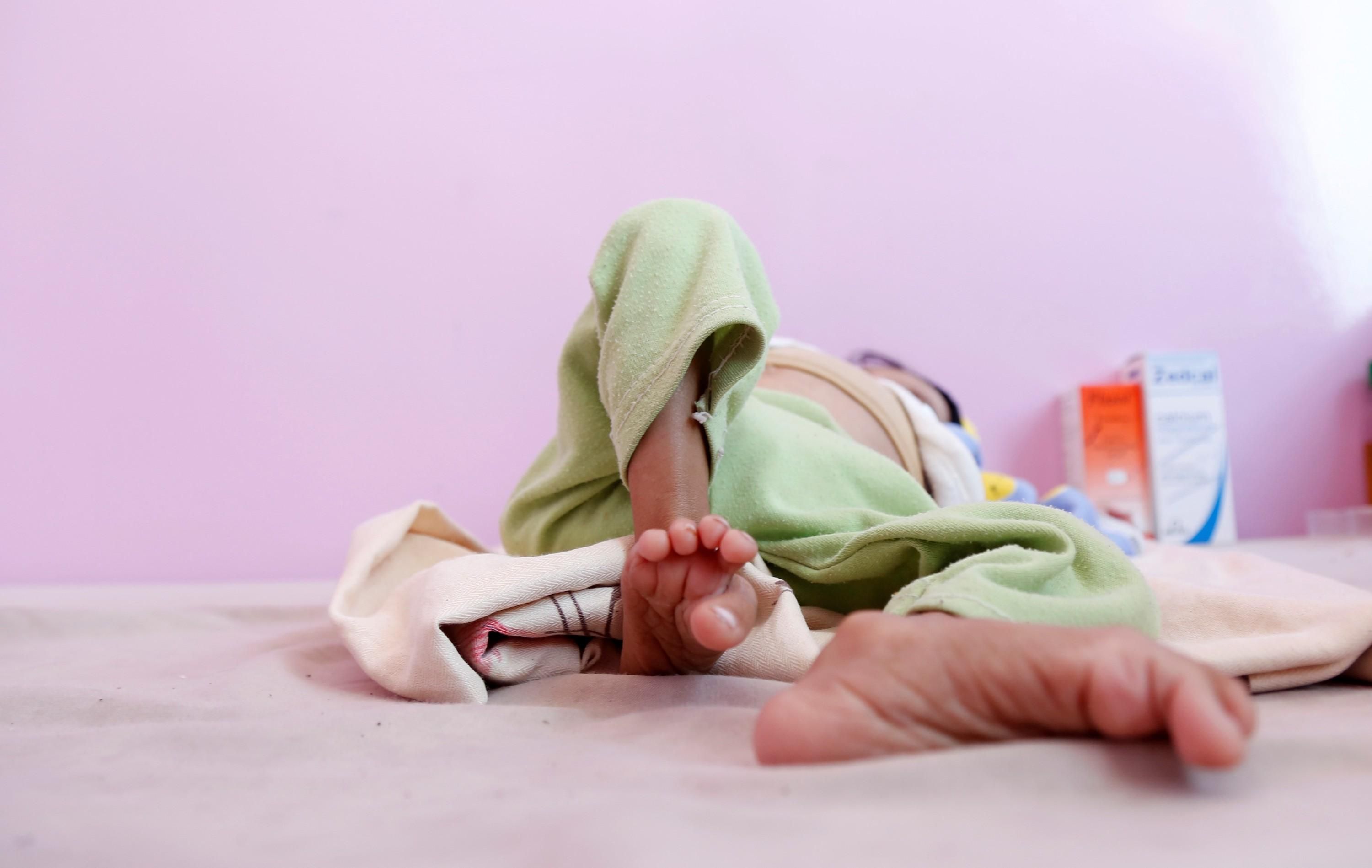 A malnourished child lies on a bed at the malnutrition treating ward in a hospital in Sanaa, Yemen, March 13, 2022.